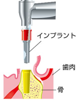 インプラントを埋め込むための穴をあけます