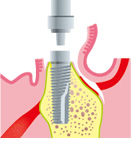 インプラント体にアバットメント（被せ物とインプラントの接続部分）を取りつけます