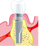 切開した歯肉が治ったら、型をとって被せ物を作製し、アバットメントにセットします
