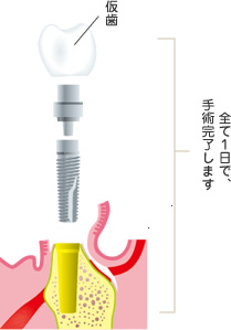 即入即時負荷その日に噛めるインプラント