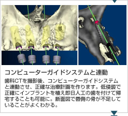 コンピューターガイドシステムと連動 歯科CTを撮影後、コンピューターガイドシステムと連動させ、正確な治療計画を作ります。低侵襲で正確にインプラントを植え即日人工の歯を付けて帰宅することも可能に。断面図で唇側の骨が不足していることがよくわかる。